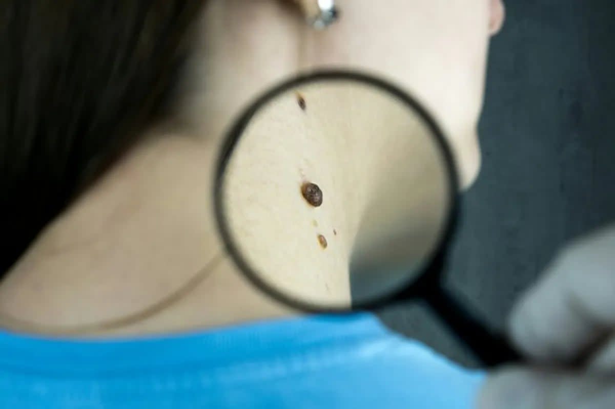 Medical professional examining patient's skin with magnifying glass during melanoma screening examination