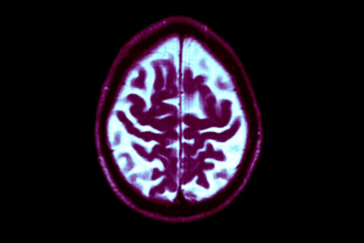 Dementia Risk Drops 13% Per Decade Since 1988 - Image 2