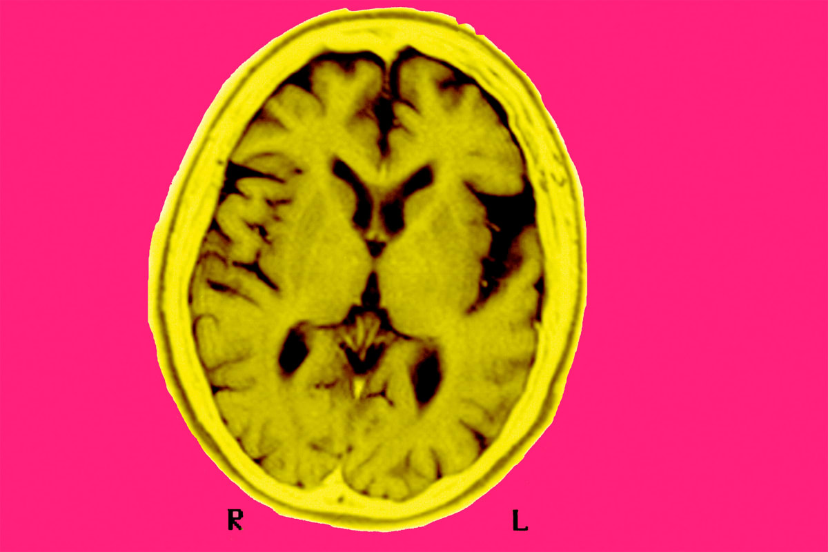 Blood Test Predicts Alzheimer's Risk Decades Early