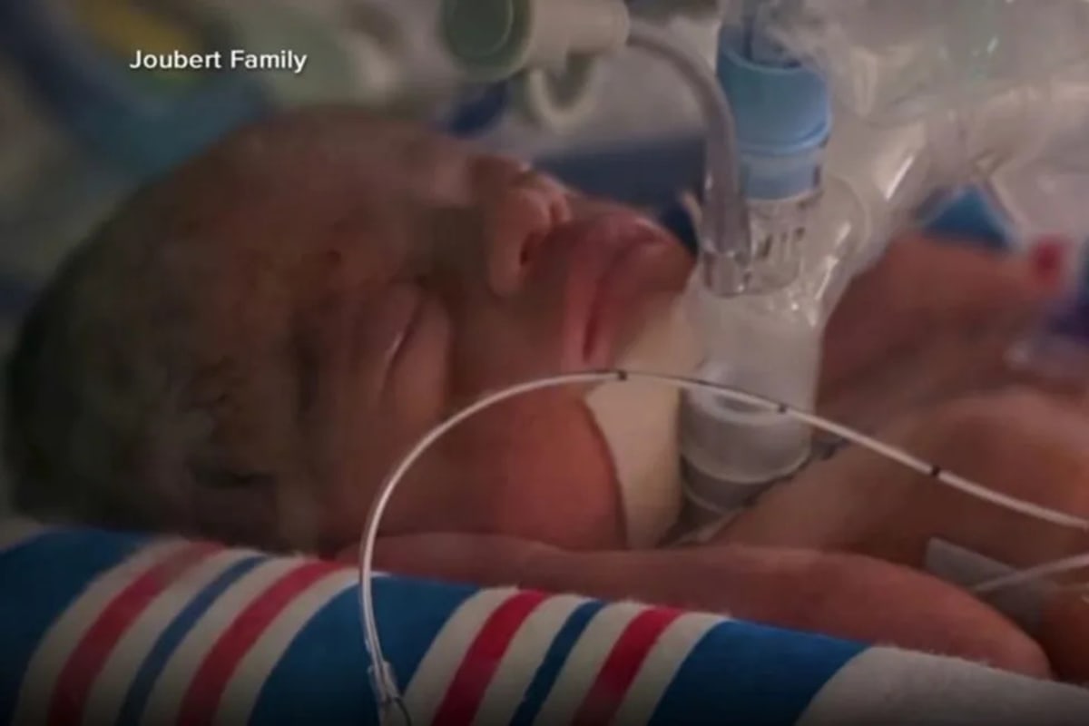 Baby Born Twice Survives Rare Surgery at 25 Weeks - Image 3