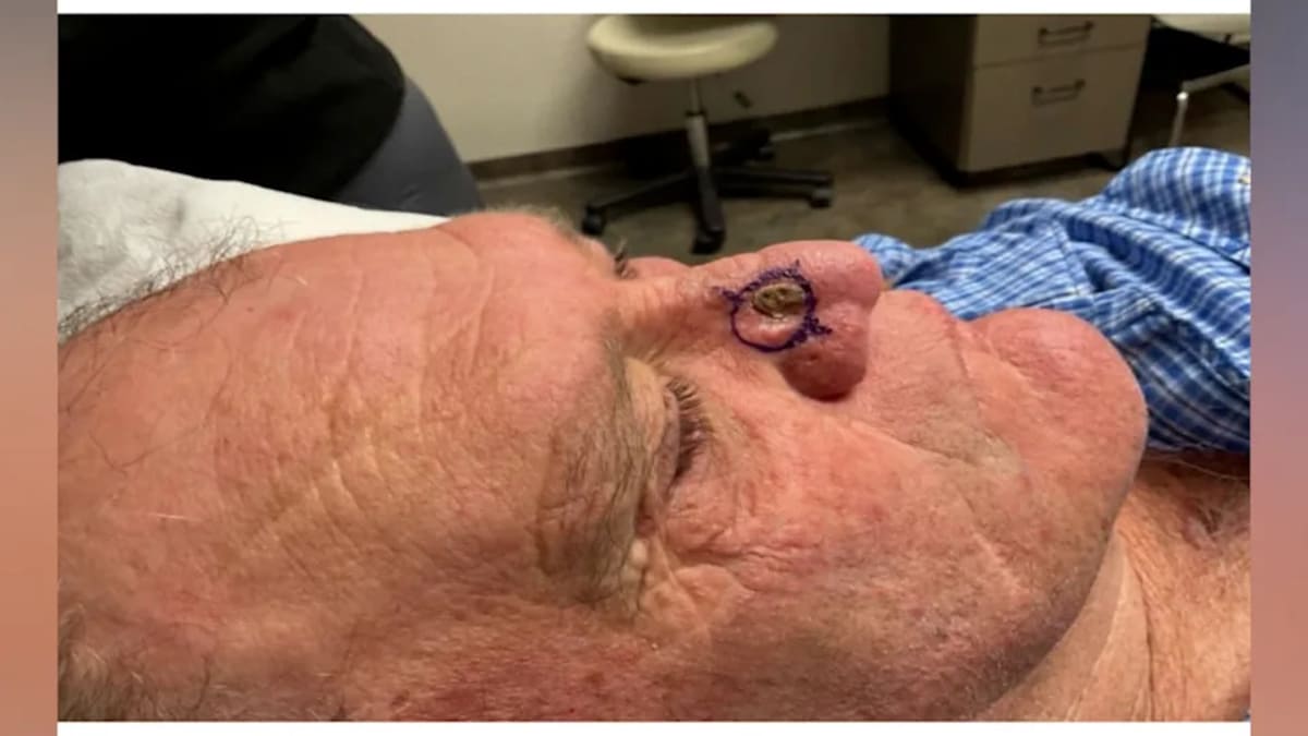 Texas Cowboy Beats Skin Cancer Thanks to Generous Doctor - Image 5