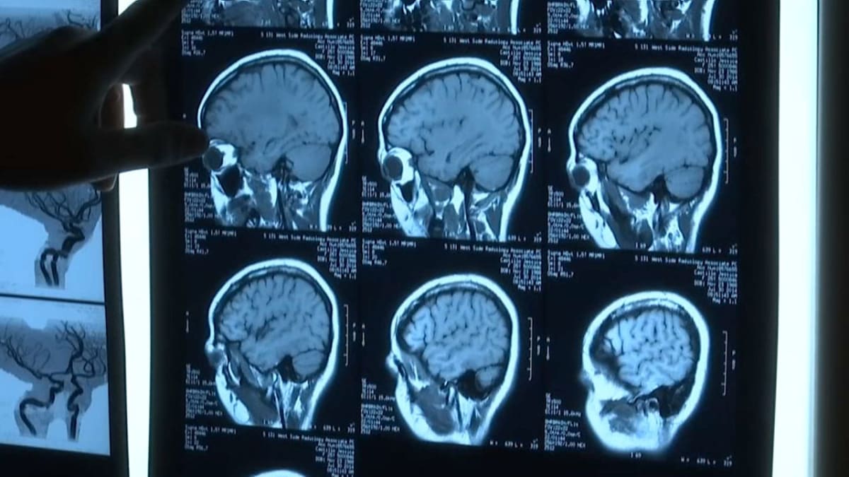 Medical researcher examining genetic data related to ALS treatment in modern laboratory setting