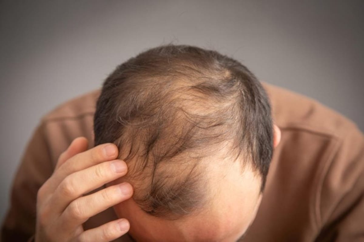 Scientists Find Protein That Could Reverse Hair Loss - Image 2