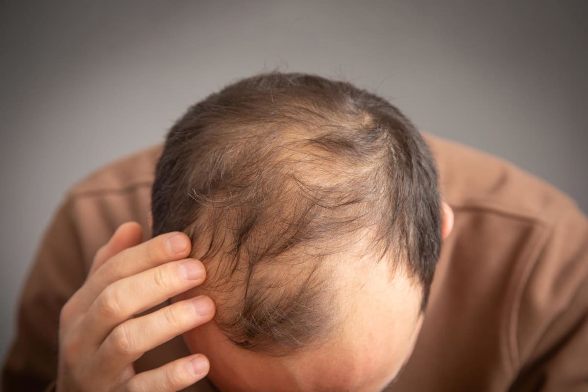 Scientists Find Protein That Could Reverse Hair Loss