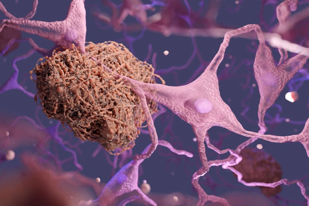 Scientists Watch Alzheimer's Protein Clumping Reverse