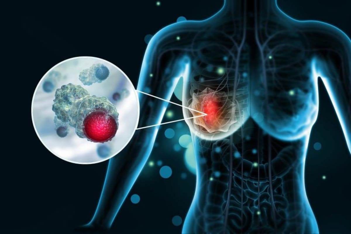 Scientists Find "Off Switch" for Spreading Breast Cancer - Image 2