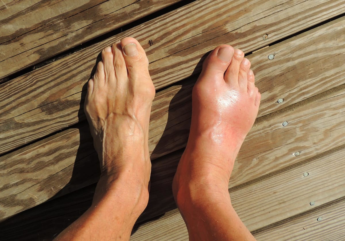 New Gout Treatment Works Better for 61% of Patients