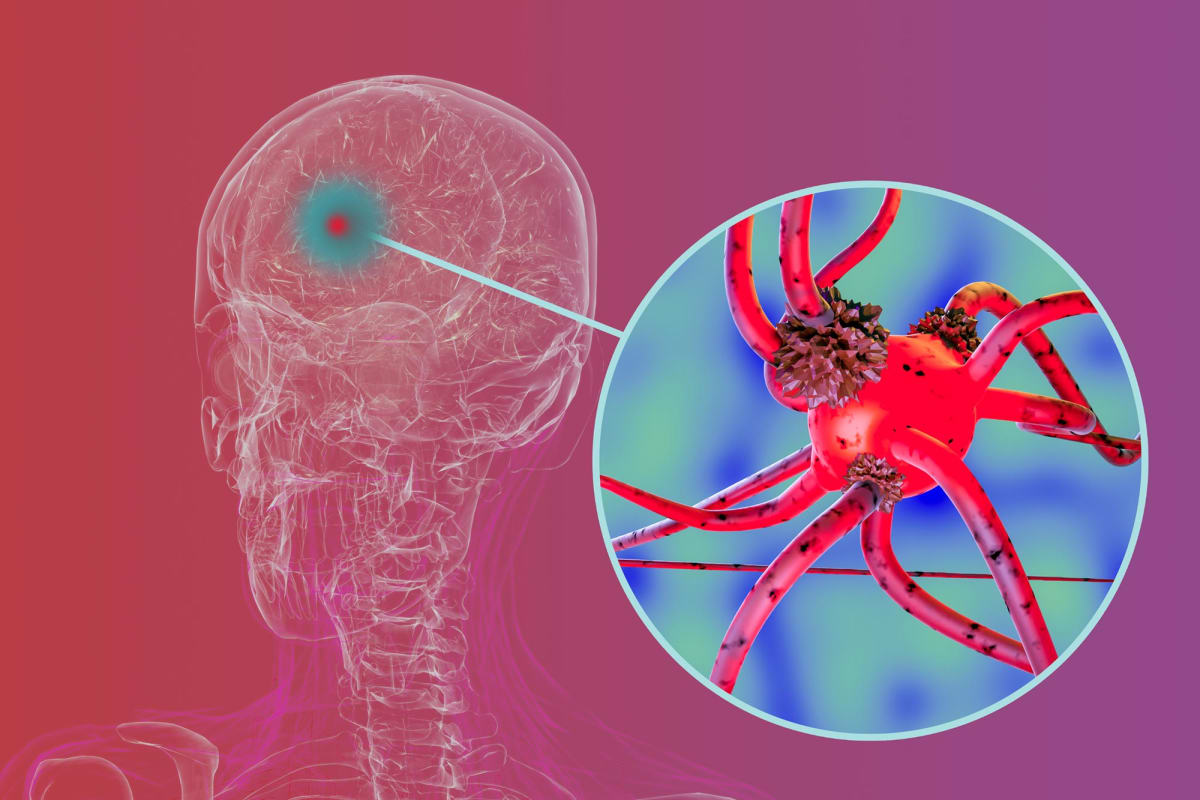 Penn Scientists Find Way to Stop Parkinson's Spread