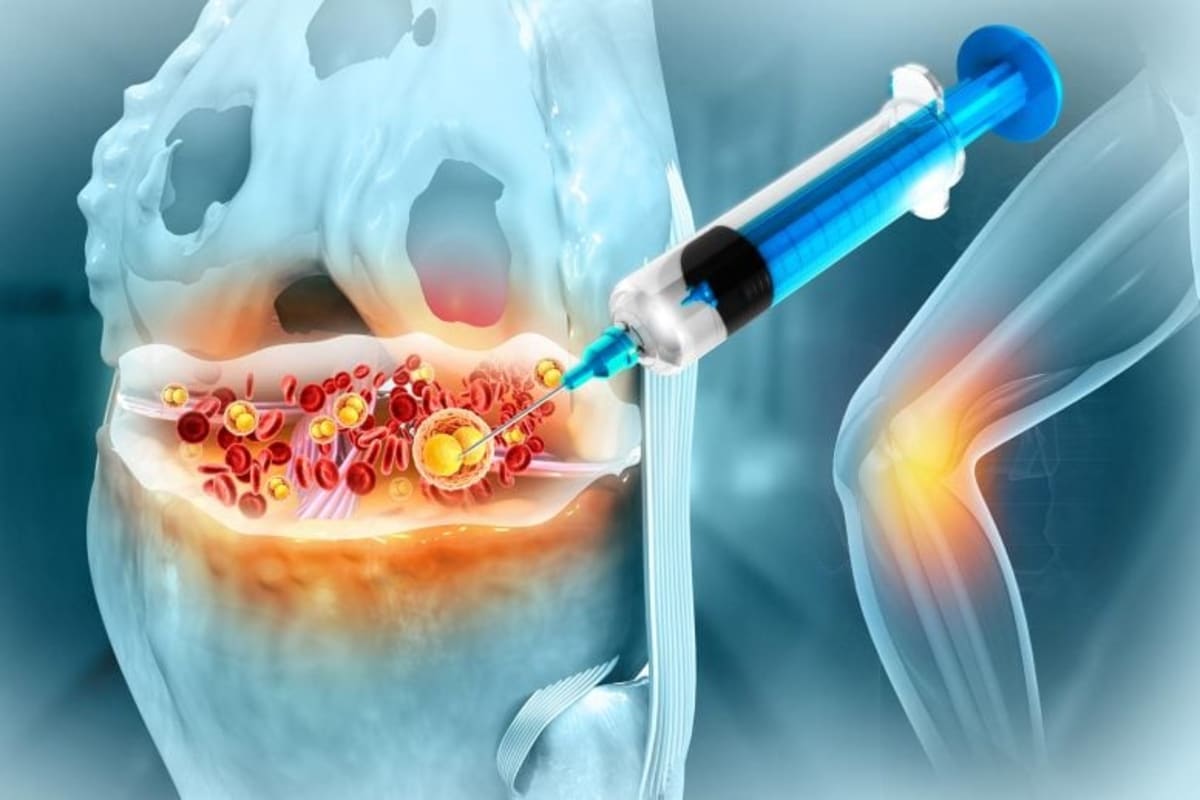 Yale Finds Epilepsy Drug Repairs Osteoarthritis Cartilage