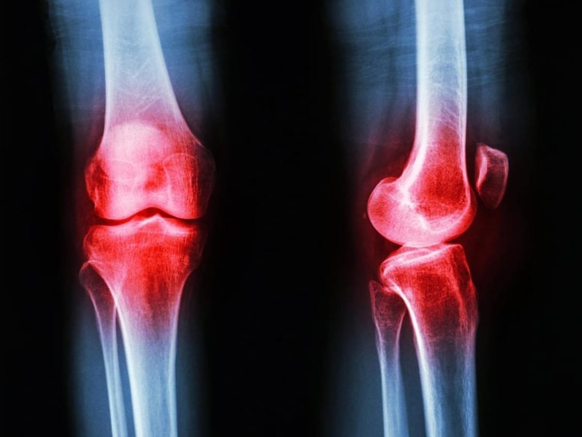Scientists Find Protein That Could Stop Arthritis Damage - Image 2