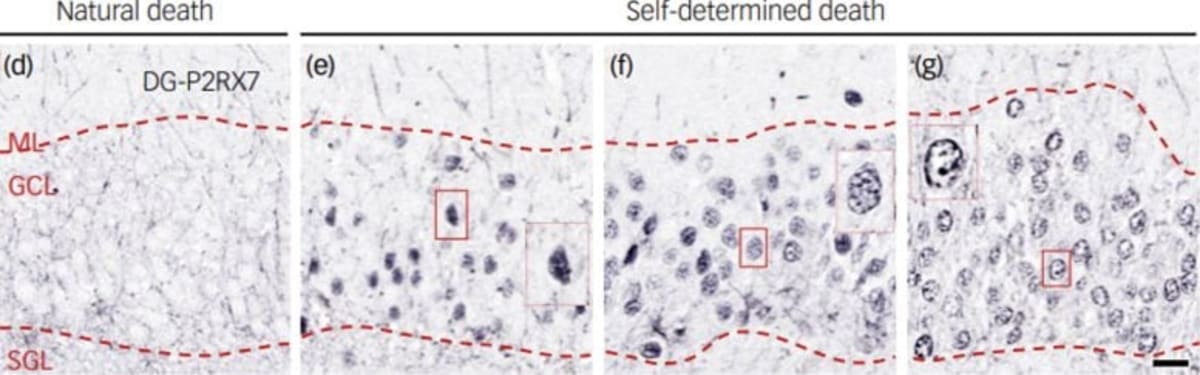 Scientists Find Brain Signal That May Predict Suicide Risk - Image 2