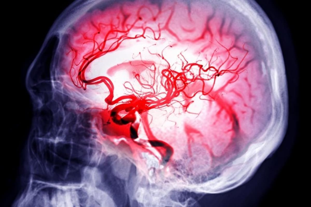 Scientists Find Way to Boost Stroke Recovery Days Later - Image 2