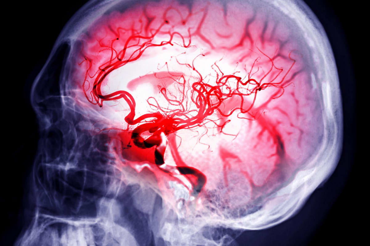 Scientists Find Way to Boost Stroke Recovery Days Later
