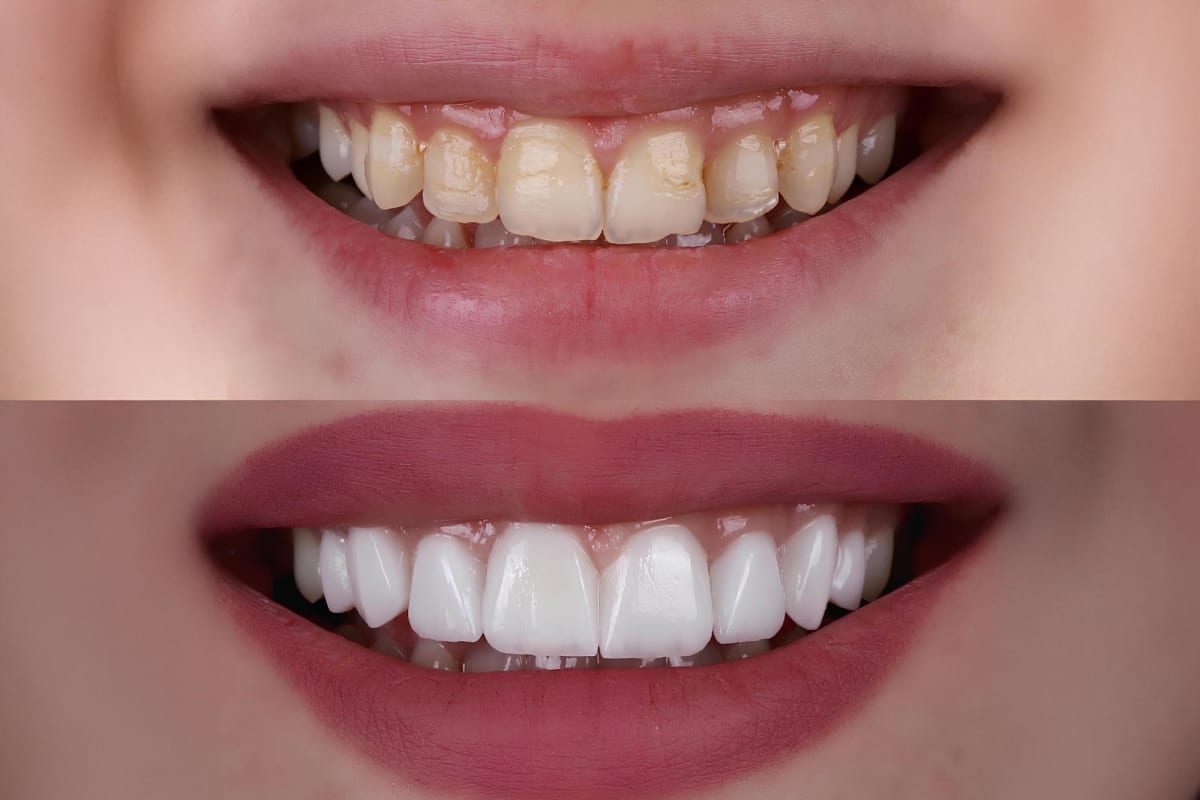 3D-printed white zirconia dental crown being processed in advanced graphite felt heating system