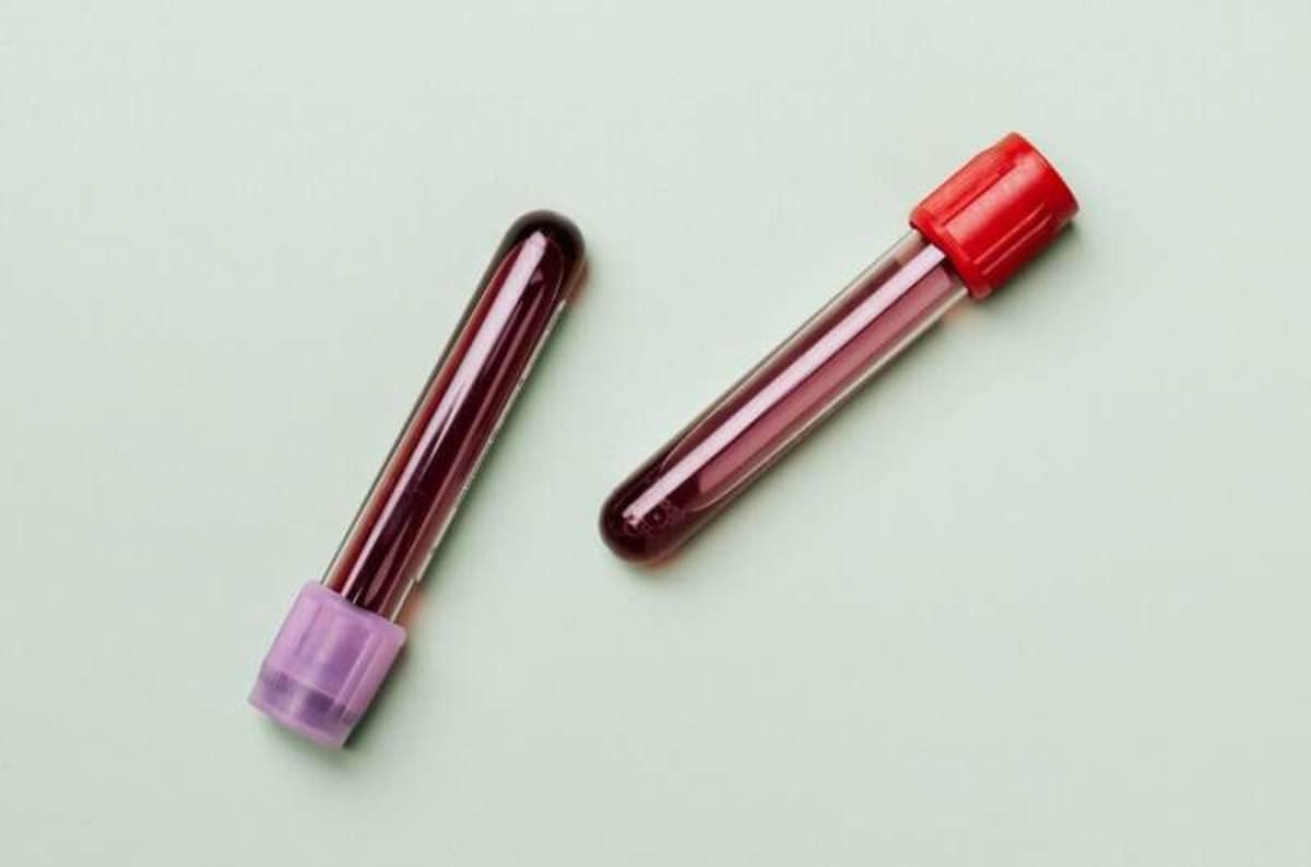 Blood Test Predicts Testicular Cancer Relapse Early - Image 3