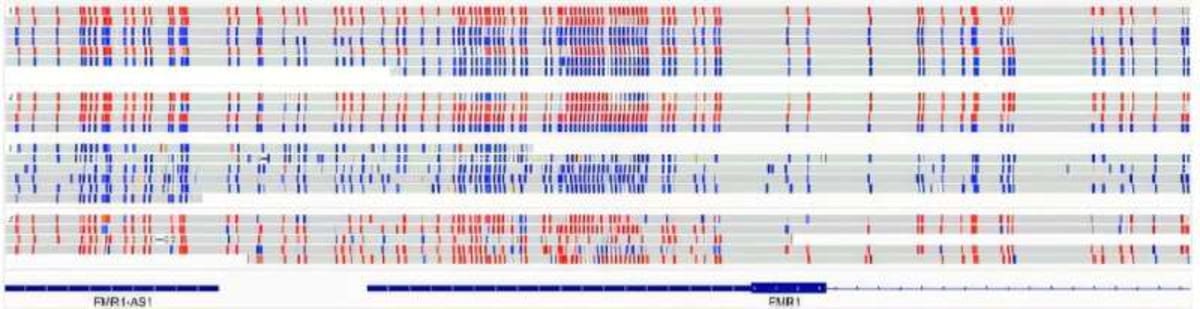New Gene Test Could Unlock Autism Answers for Families