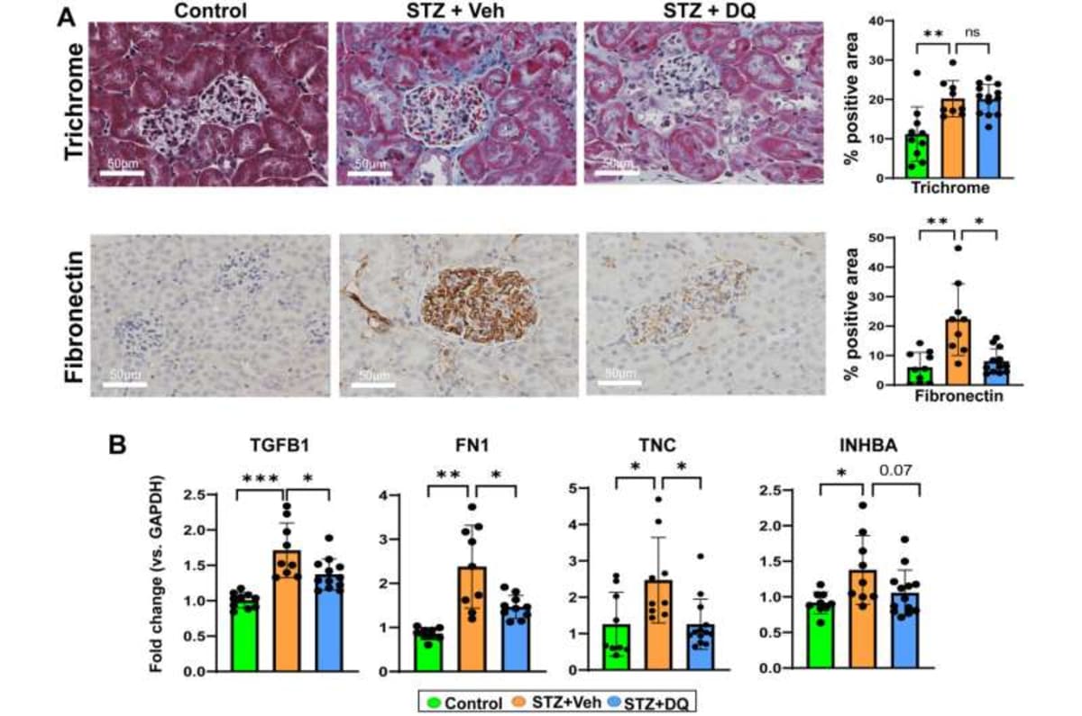 New Drug Combo Fights Kidney Disease in 12M Americans - Image 3