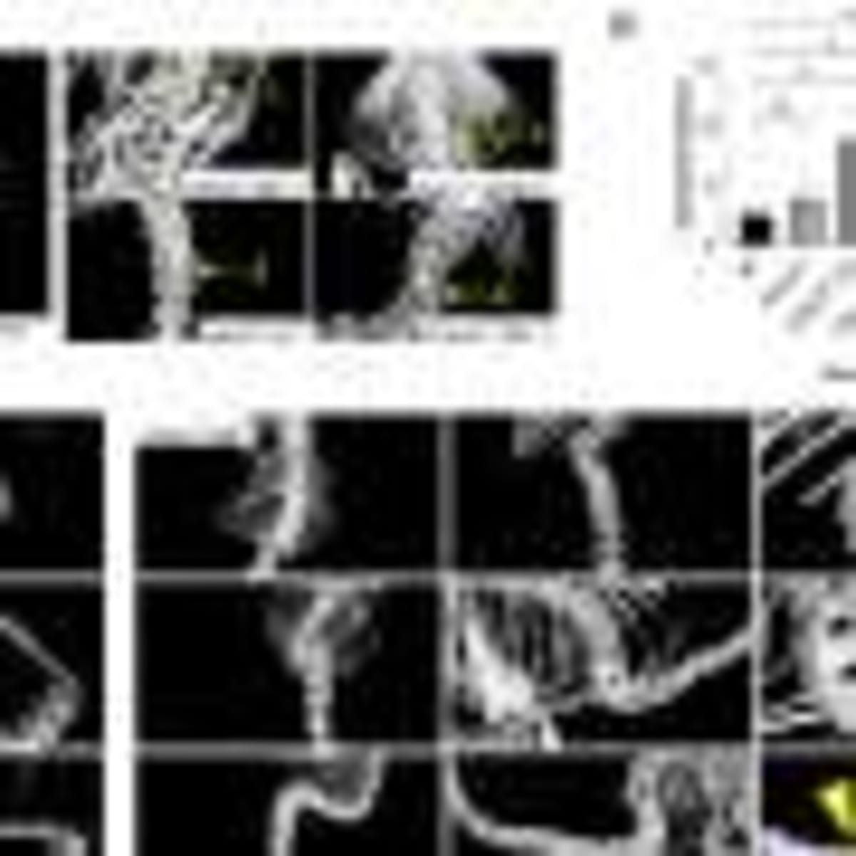 New Leukemia Treatment Boosts Remission Rates to 75% - Image 4