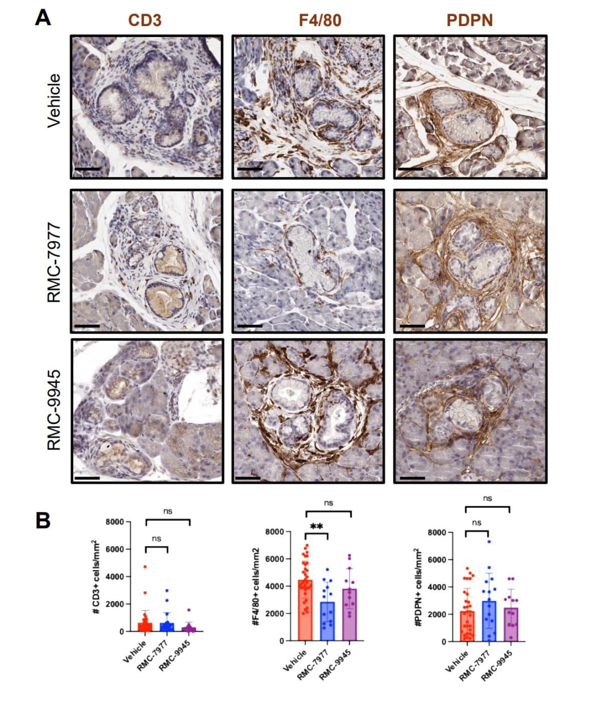 Microscope view of pancreatic cells showing precancerous lesions being targeted by experimental therapy