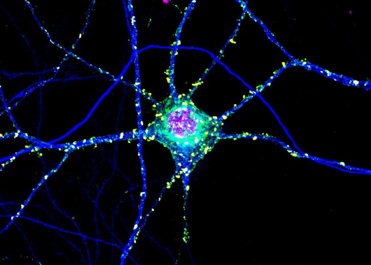 Huntington's Protein Clumps May Actually Protect the Brain