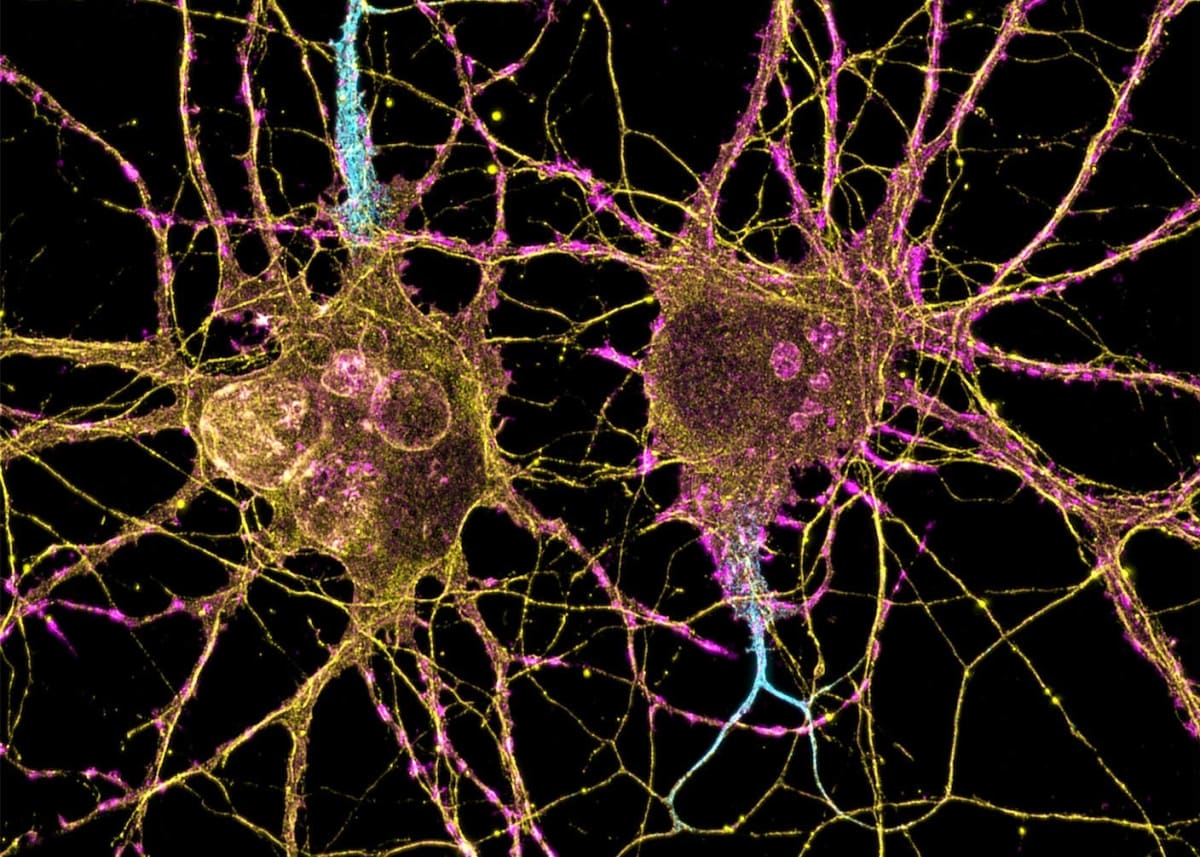 Single Shot Eases MS Symptoms in 16-Patient Trial - Image 5