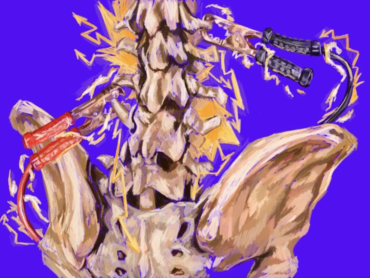 Brown Implant Restores Feeling for Paralyzed Patients - Image 2