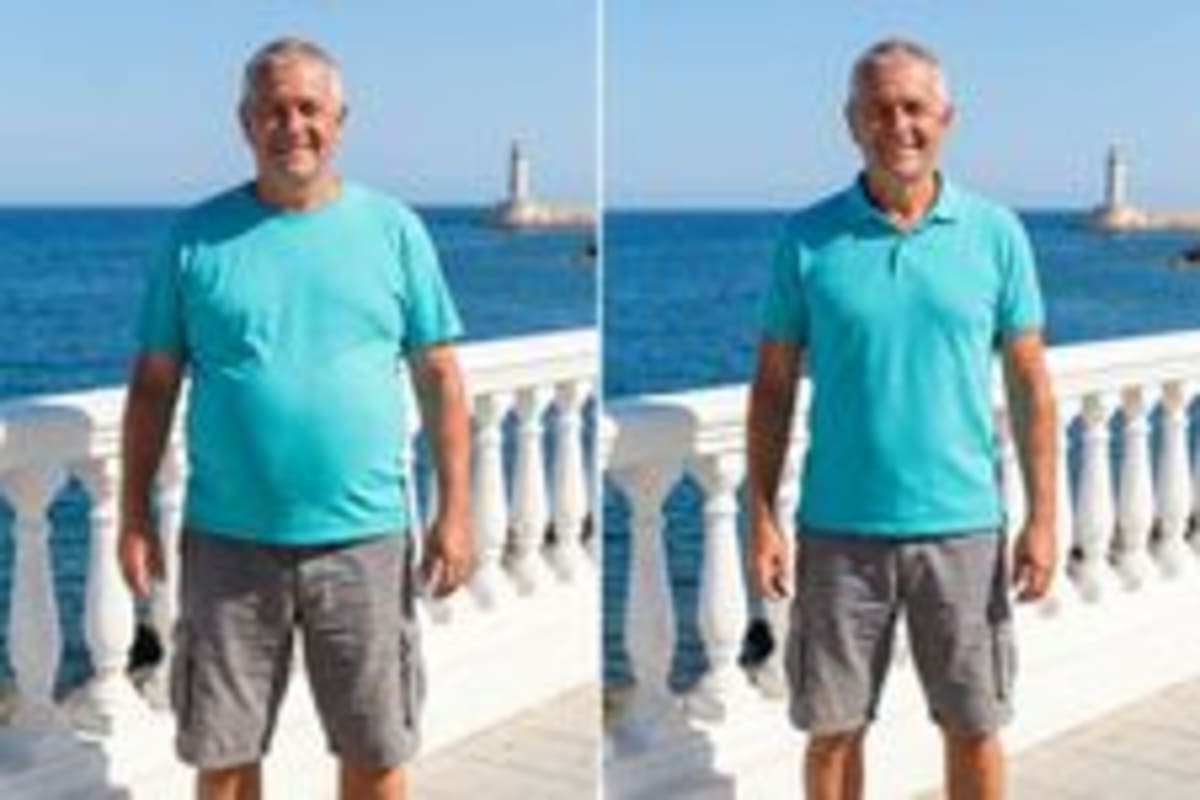 Arthritis Drug Restores Hair in 1,400 Alopecia Patients - Image 5