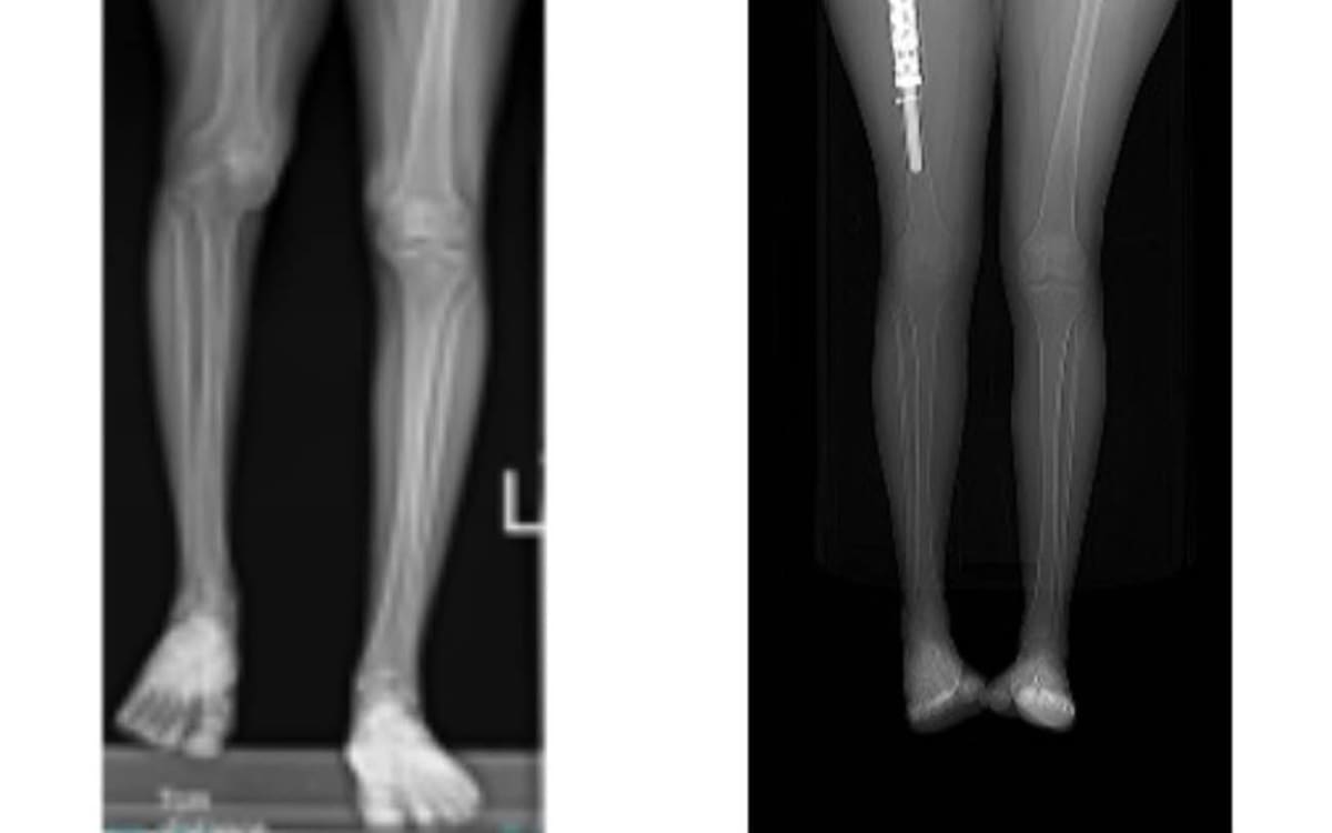 Woman Walks Unaided After 3D-Printed Bone Saves Her Leg