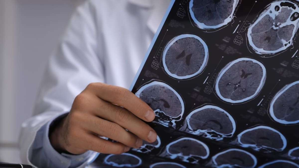Tapeworms in Brain Mistaken for Cancer, Man Fully Recovers