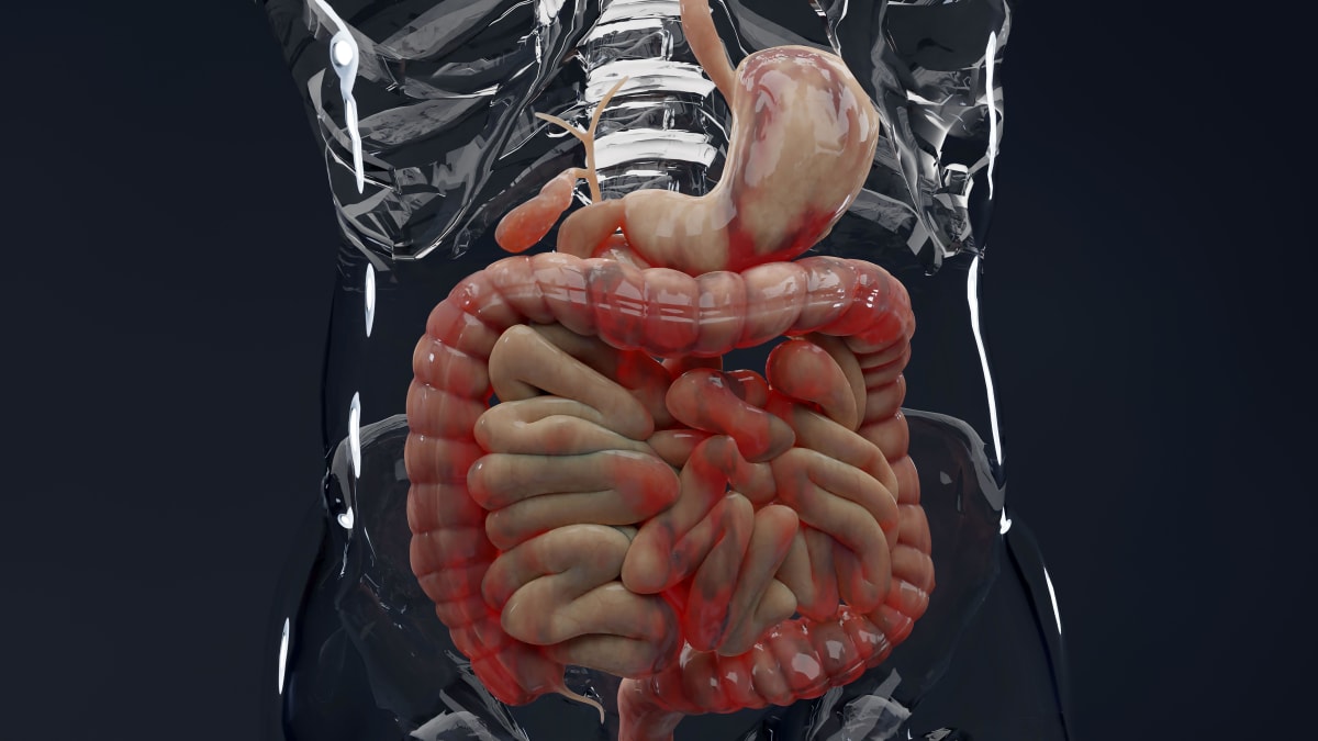 Scientists Find Crohn's Disease Trigger for New Treatments - Image 2