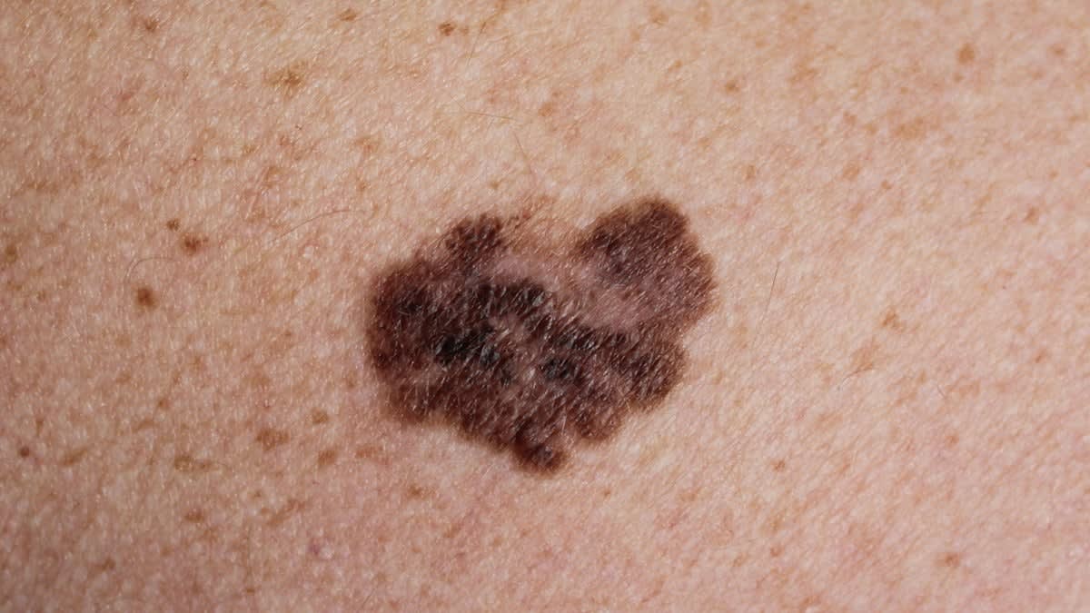 Personalized Cancer Vaccine Stops Melanoma From Returning - Image 3