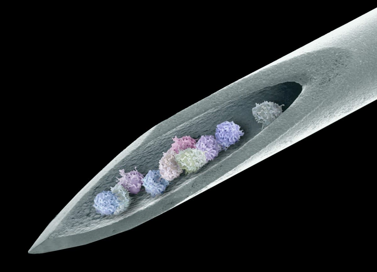 Two People Disease-Free 15 Years After Stem Cell Treatment