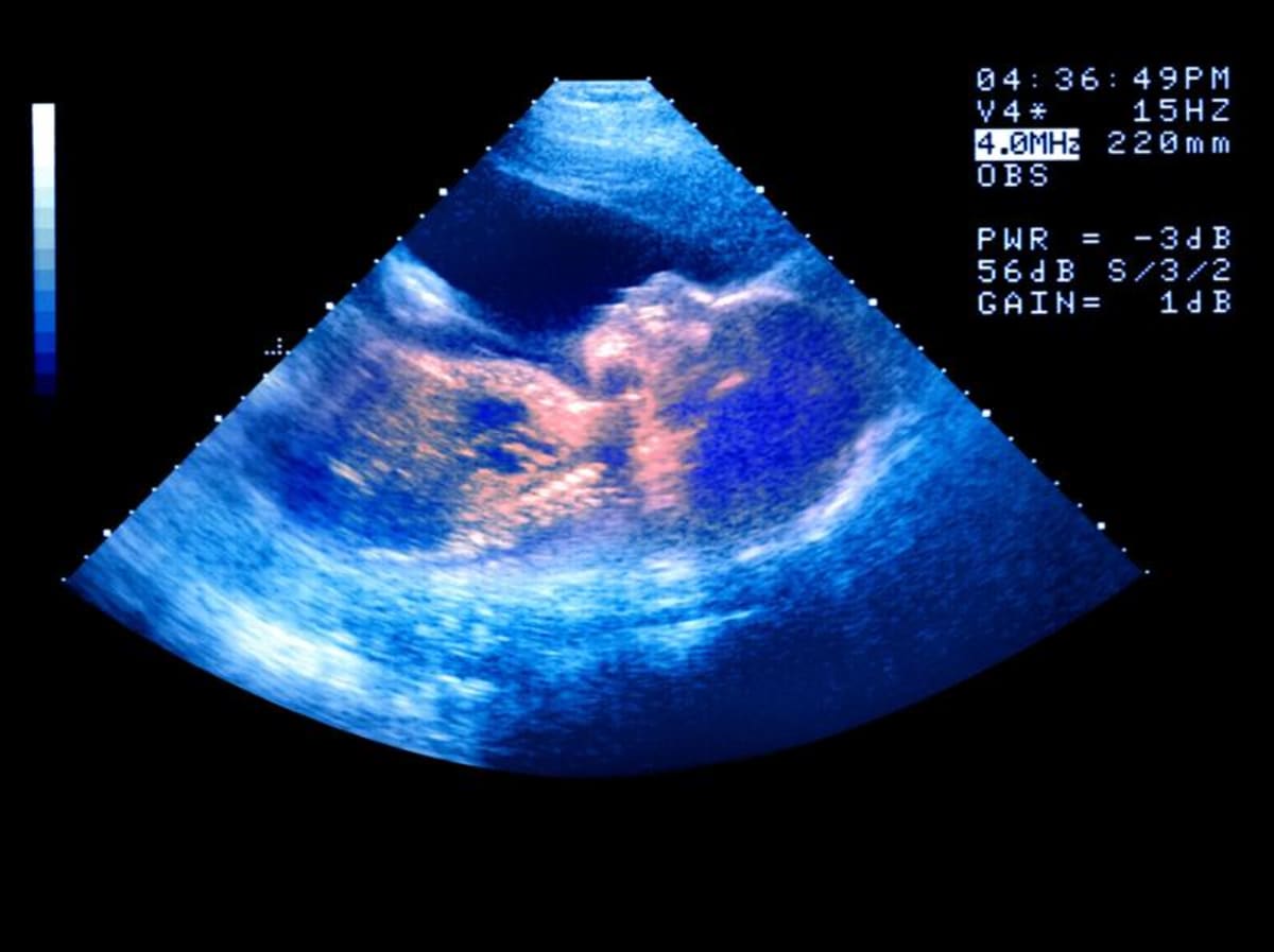 Babies Catch Yawns From Mom While Still in the Womb