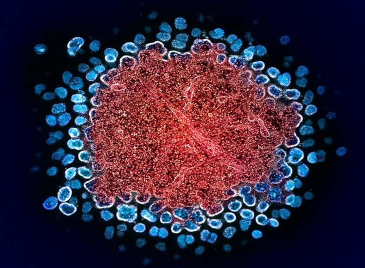 Man Cured of HIV After Bone Marrow Transplant From Brother - Image 2