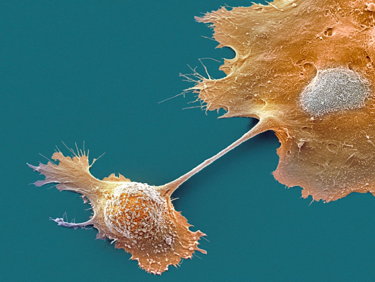 New Blood Test Detects Pancreatic Cancer 87% of the Time
