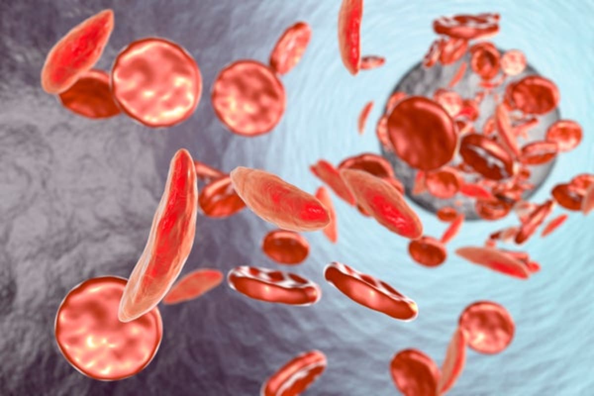 Gene Therapy Cures Sickle Cell Disease After 20-Year Quest - Image 2
