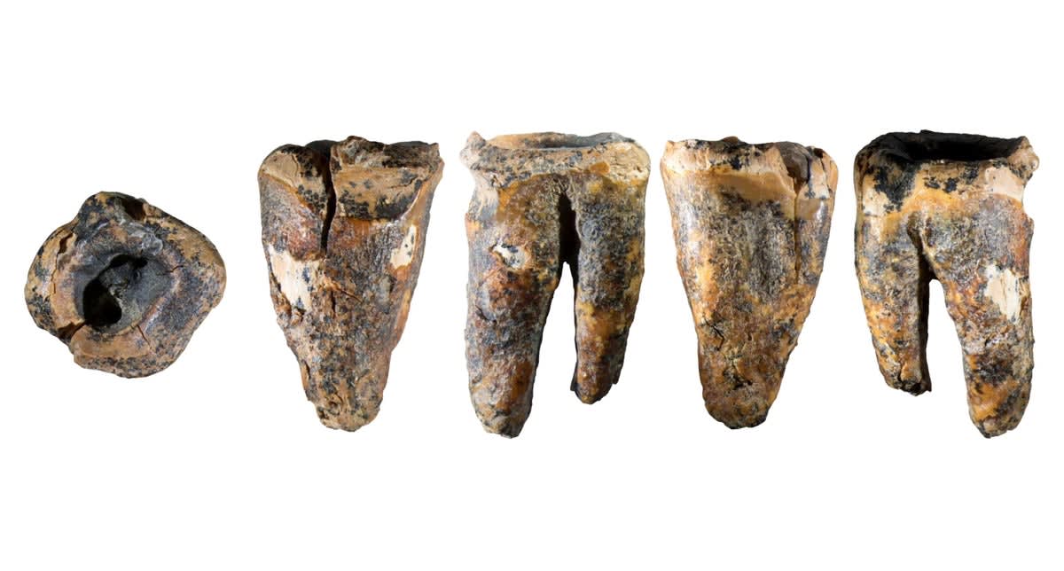 Ancient Neanderthal molar with vertical hole showing possible evidence of early dentistry