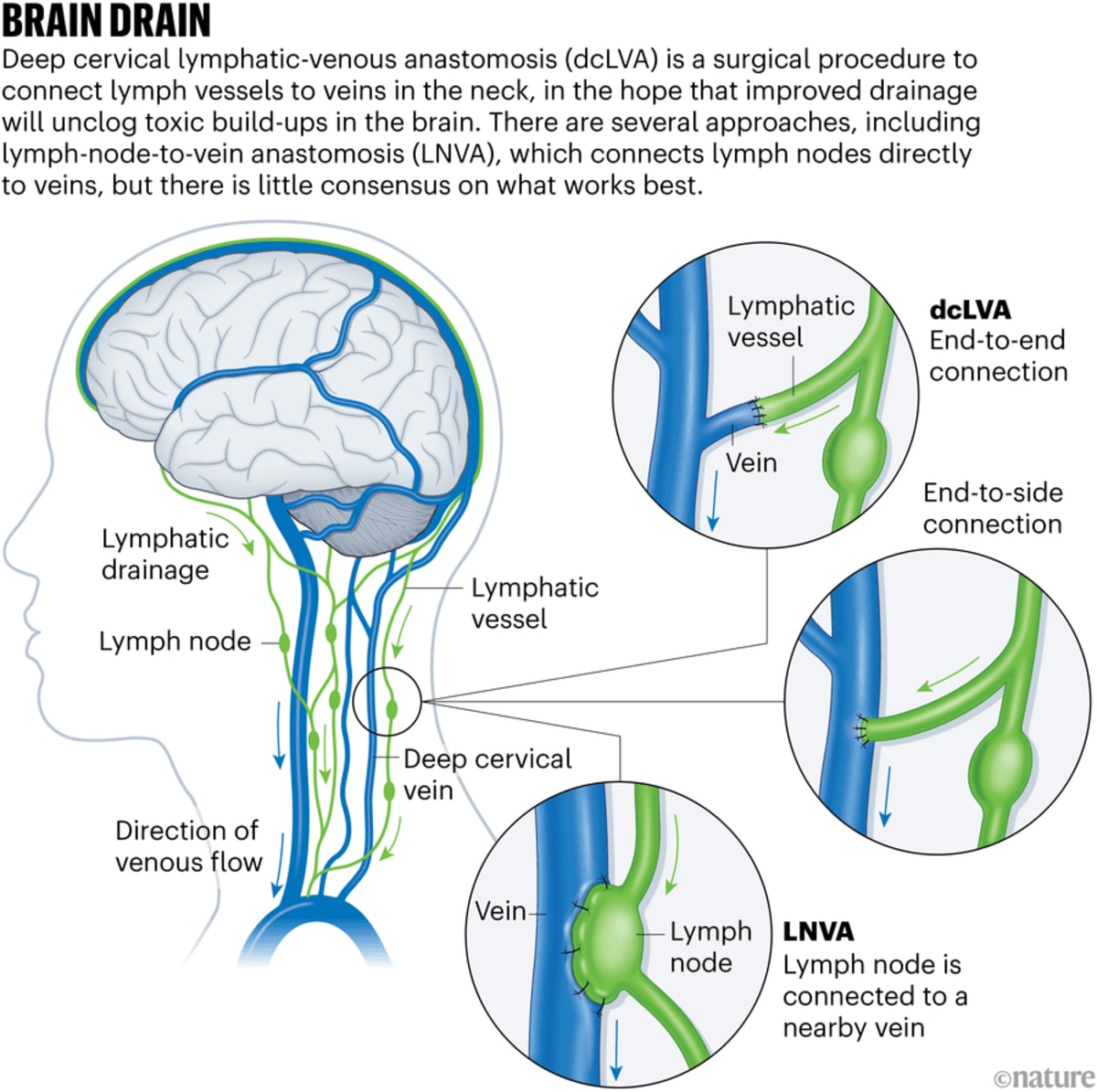 New Brain Surgery Shows Promise for Alzheimer's Patients - Image 3