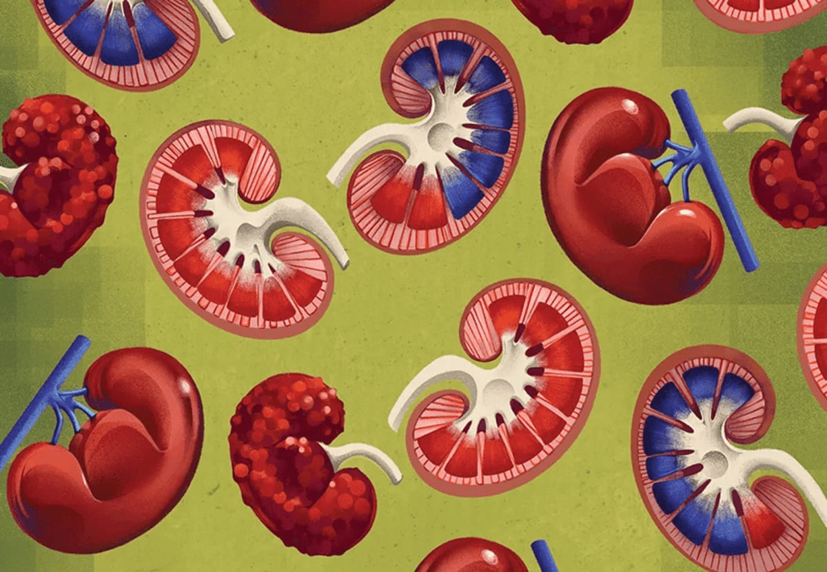 Breakthrough Kidney Drugs Give Millions New Hope