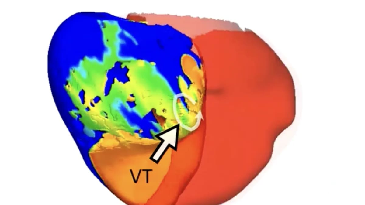 3D digital model of human heart showing electrical pathways used for surgical planning