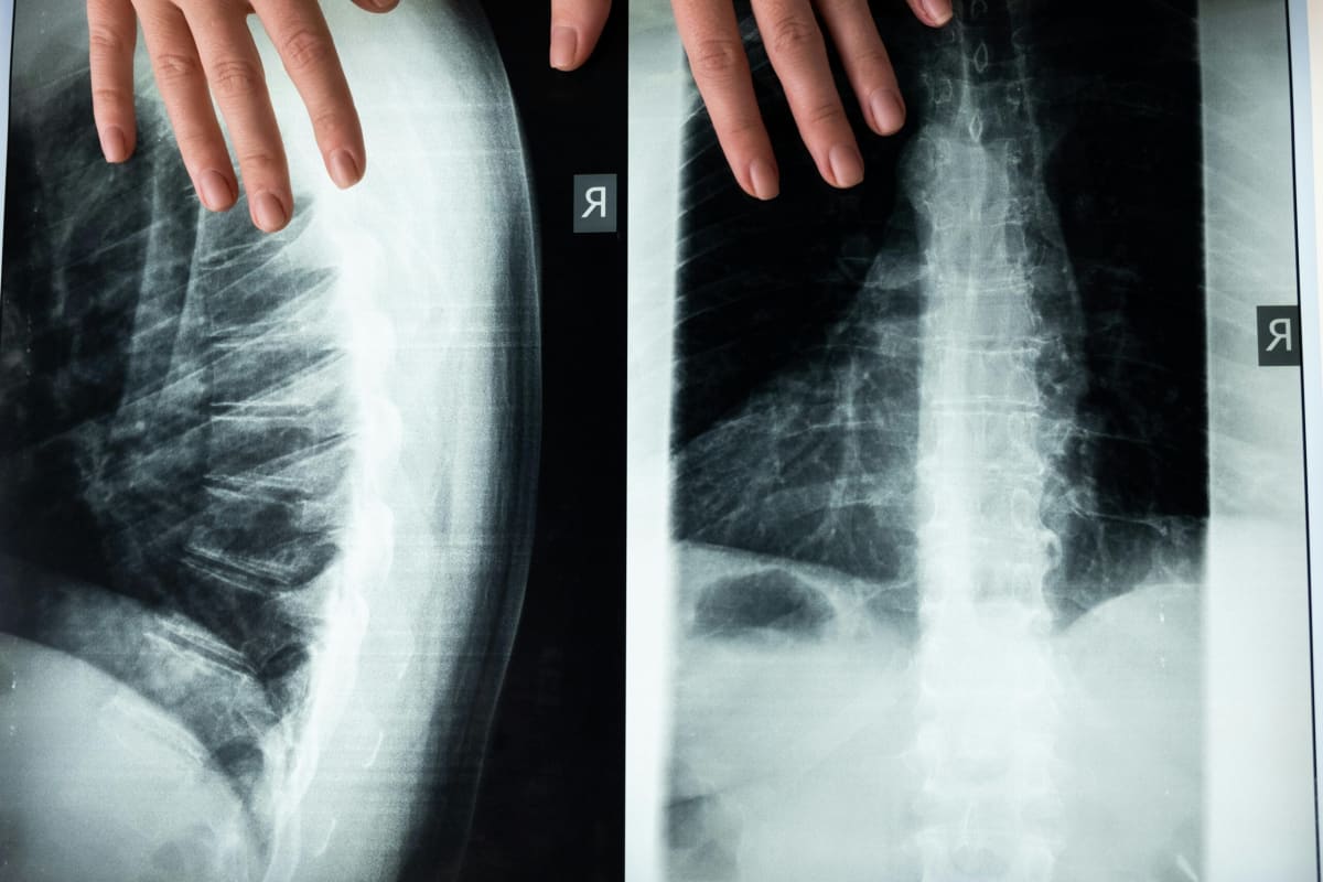 Spinal Injury Treatment Shows 80% Recovery in Study