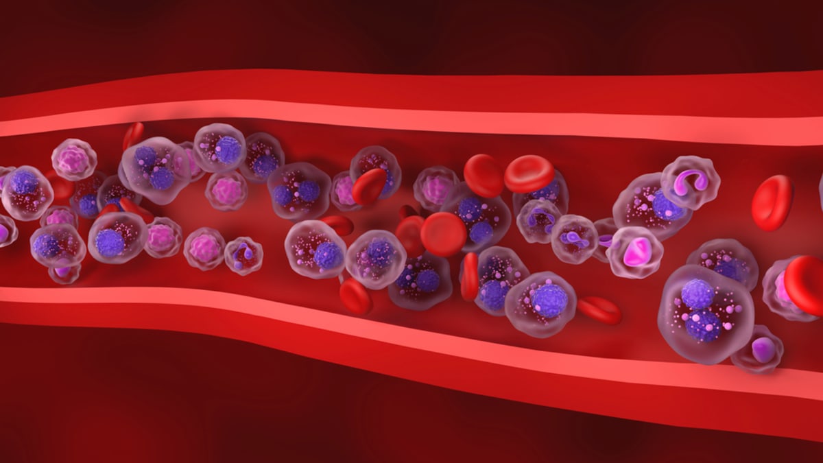 Medical researcher examining blood samples in laboratory for multiple myeloma cancer treatment research