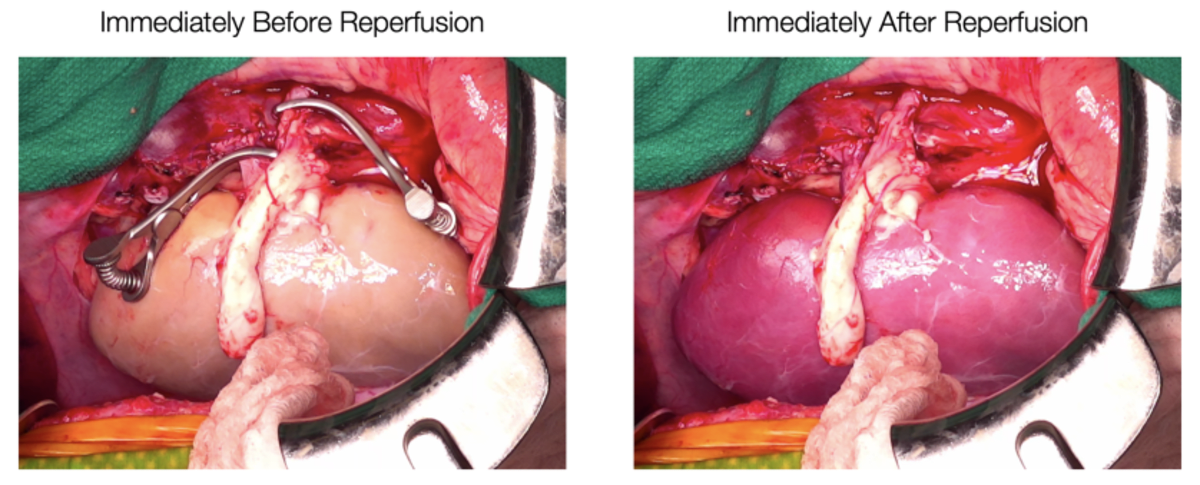 Supercooled Kidneys Last 3 Days, Could Save Thousands - Image 2
