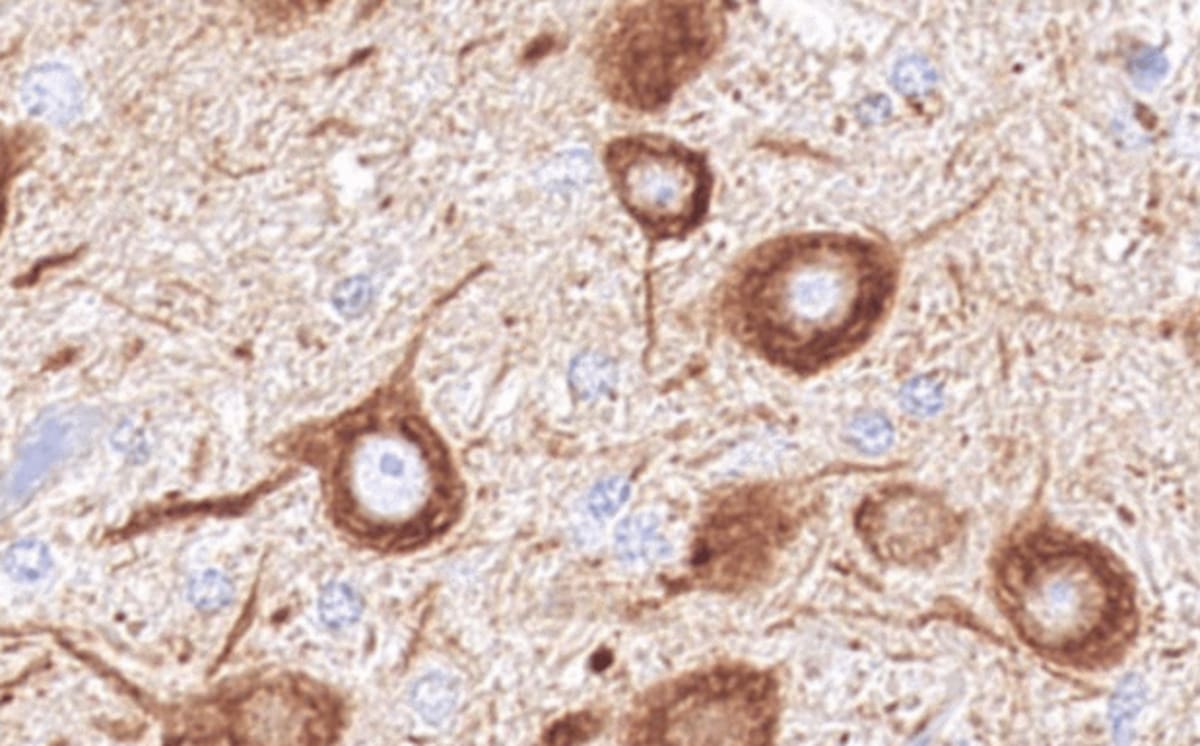 Gene Therapy Shows Promise for Fatal Childhood Disease