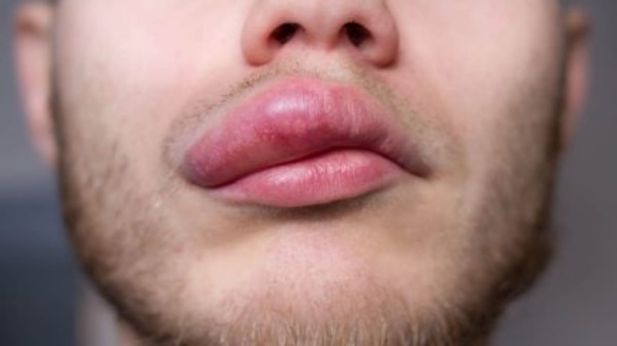 New Drug Cuts Rare Swelling Attacks by 96% in Trial - Image 2
