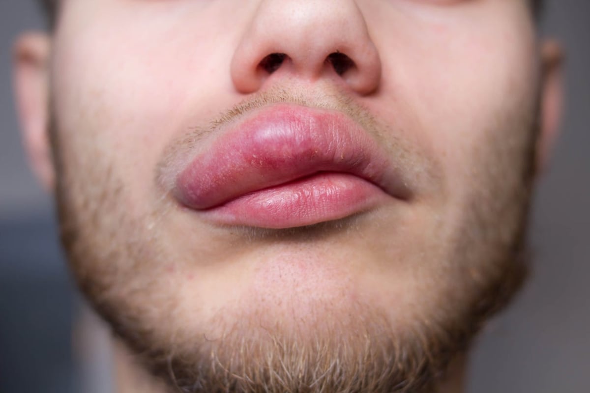 New Drug Cuts Rare Swelling Attacks by 96% in Trial