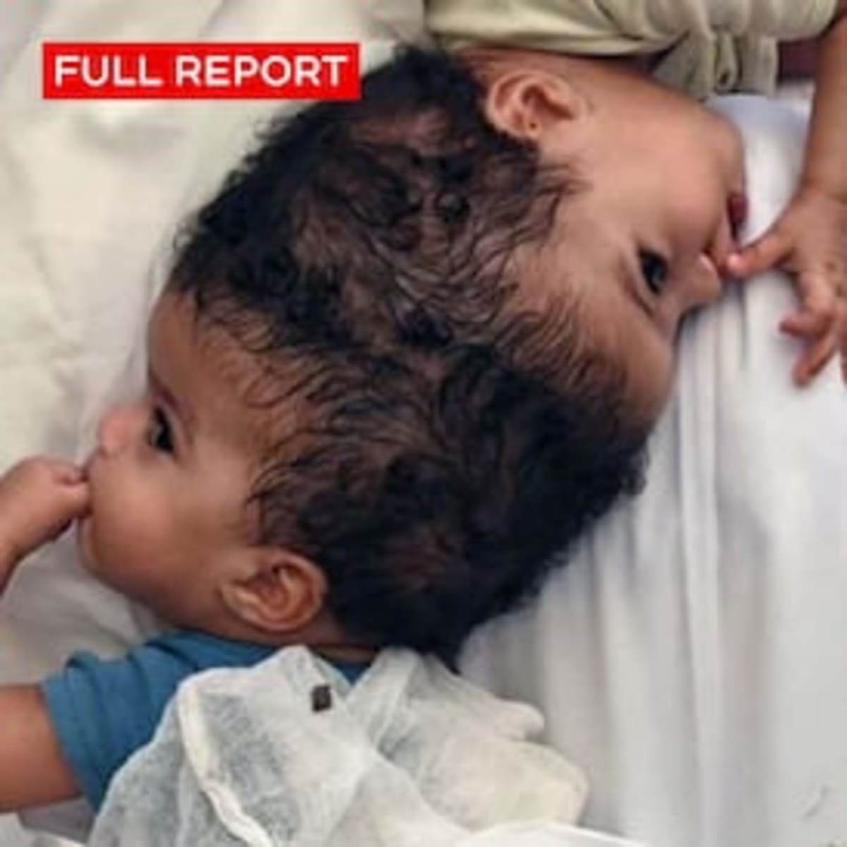 Twin Sisters Born Joined at Head Successfully Separated - Image 4