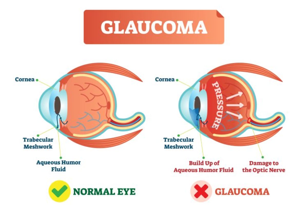 Duke Scientists Find New Way to Stop Glaucoma Blindness - Image 2