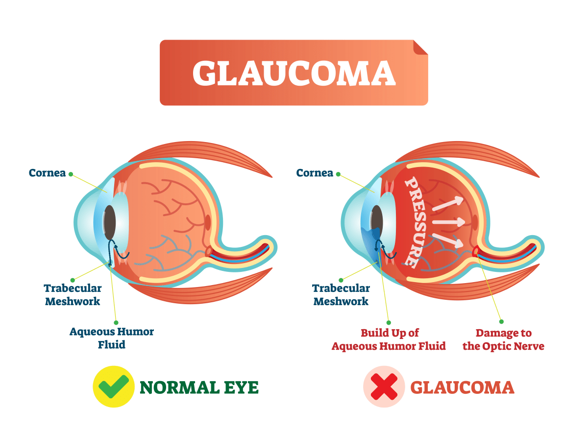 Duke Scientists Find New Way to Stop Glaucoma Blindness