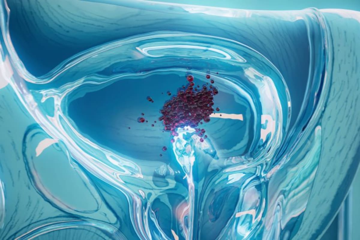 Blood Test May Predict Bladder Cancer Treatment Success - Image 2